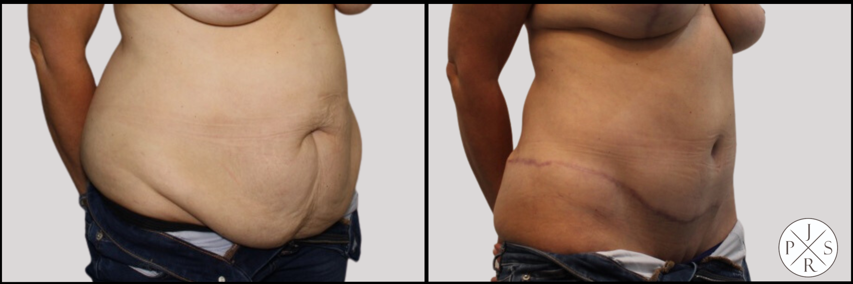 Abdominoplasty Before & After Image